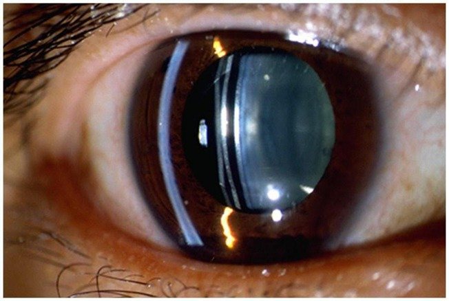 Implantable Contact Lens
