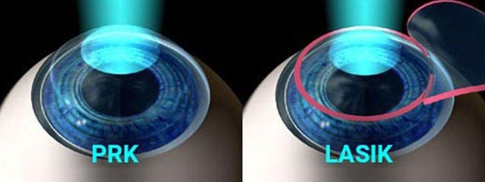 Types of Refractive Surgeries