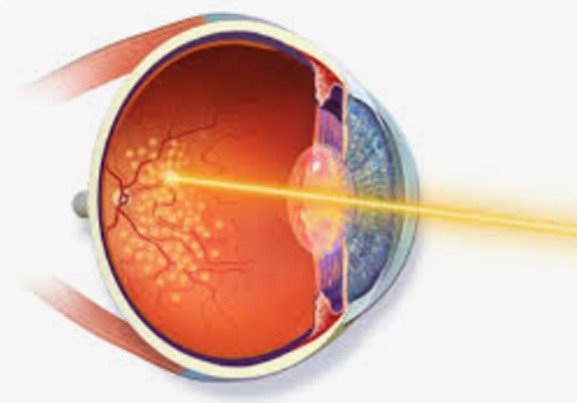 Treatment for  Diabetic Retinopathy 