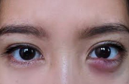 External Eye Disorders