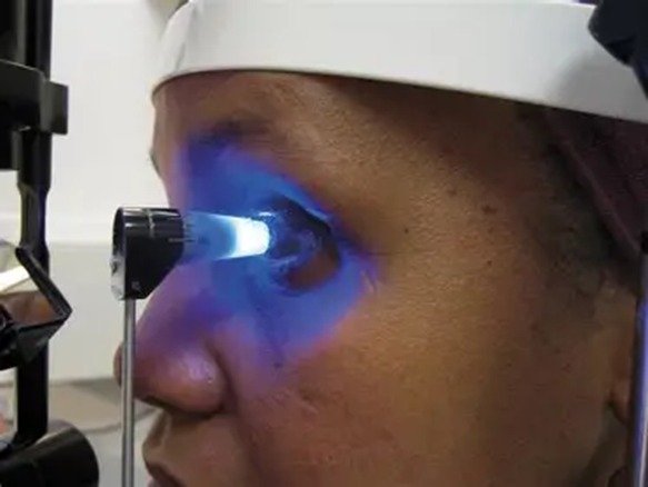Diagnosis of Glaucoma