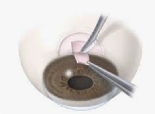 Treatment of glaucoma