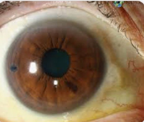 Laser peripheral iridotomy