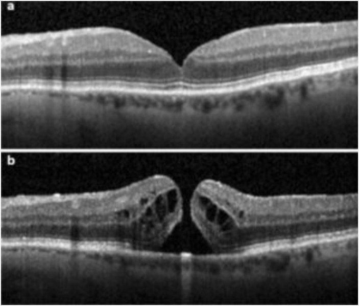 Macular Hole