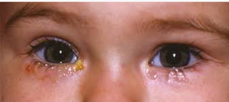 Congenital NLDO