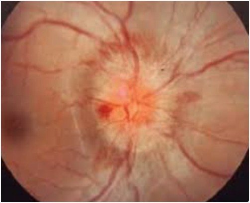 Optic Neuritis