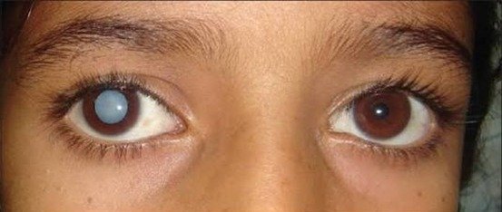 Paediatric Cataract Surgery