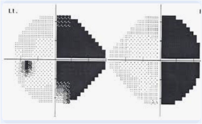 Perimetry in Stroke