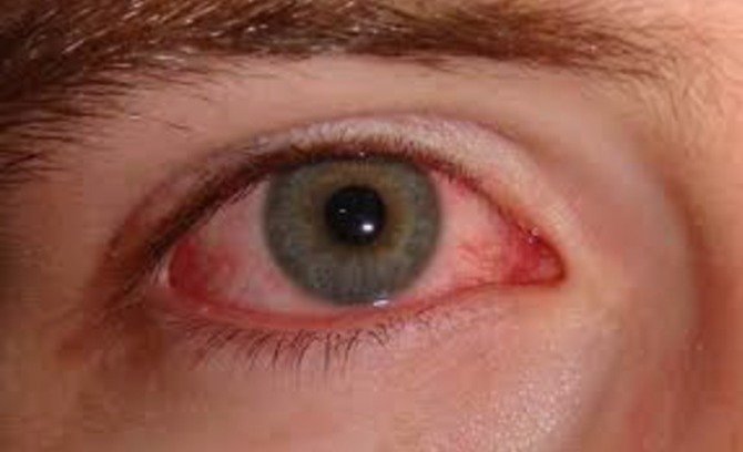 Conjunctivitis