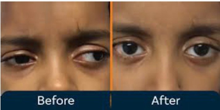 Squint Treatment
