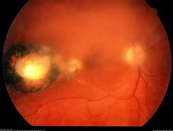 Toxoplasma retinochoroiditis