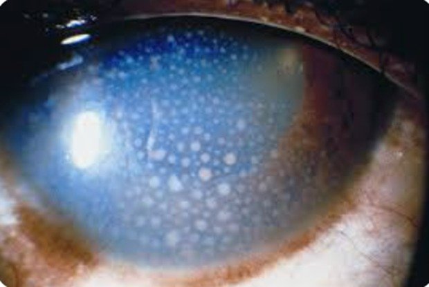 Tubercular uveitis